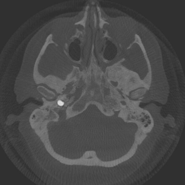 File:Acute subarachnoid hemorrhage and accessory anterior cerebral artery (Radiopaedia 69231-79010 Axial arterial - MIP 11).jpg