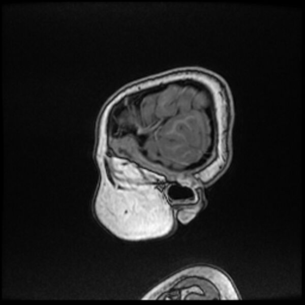 File:Adamantinomatous craniopharyngioma (Radiopaedia 77407-89529 Sagittal T1 C+ 11).jpg