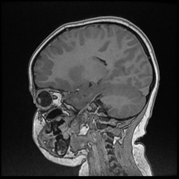 File:Adamantinomatous craniopharyngioma (Radiopaedia 77407-89529 Sagittal T1 C+ 85).jpg