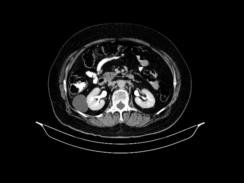 Adenocarcinoma of pancreas with hepatic metastasis (Radiopaedia 64332-73122 Axial C+ delayed 43).jpg
