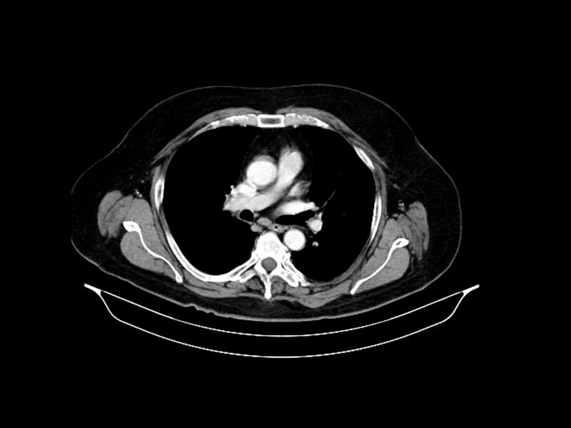 File:Adenocarcinoma of pancreas with hepatic metastasis (Radiopaedia 64332-73122 Axial C+ portal venous phase 1).jpg