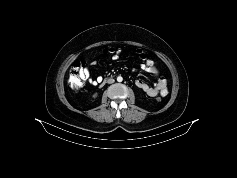 File:Adenocarcinoma of pancreas with hepatic metastasis (Radiopaedia 64332-73122 Axial C+ portal venous phase 53).jpg