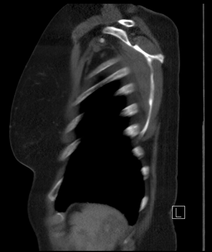 Adenocarcinoma of the lung (Radiopaedia 44205-47803 Sagittal C+ portal venous phase 6).jpg