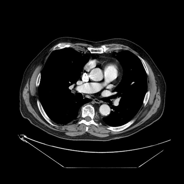 File:Adenocarcinoma of the lung (Radiopaedia 44876-48759 Axial C+ portal venous phase 43).jpg