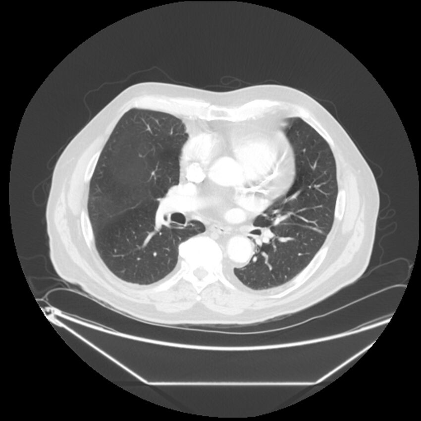 Adenocarcinoma of the lung (Radiopaedia 44876-48759 Axial lung window 42).jpg