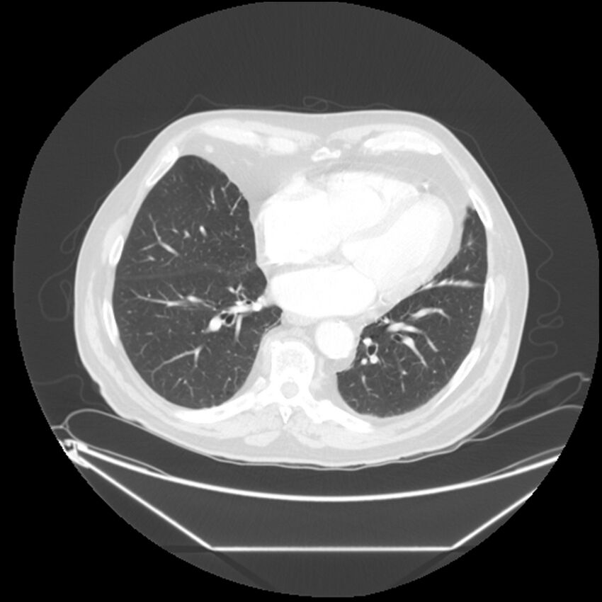 Adenocarcinoma of the lung (Radiopaedia 44876-48759 Axial lung window 53).jpg
