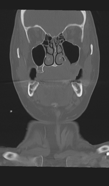 File:Adenoid cystic tumor of palate (Radiopaedia 46980-51518 Coronal bone window 24).png