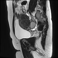 Adenomyosis - ovarian endometriomas (Radiopaedia 67031-76350 Sagittal T2 19).jpg