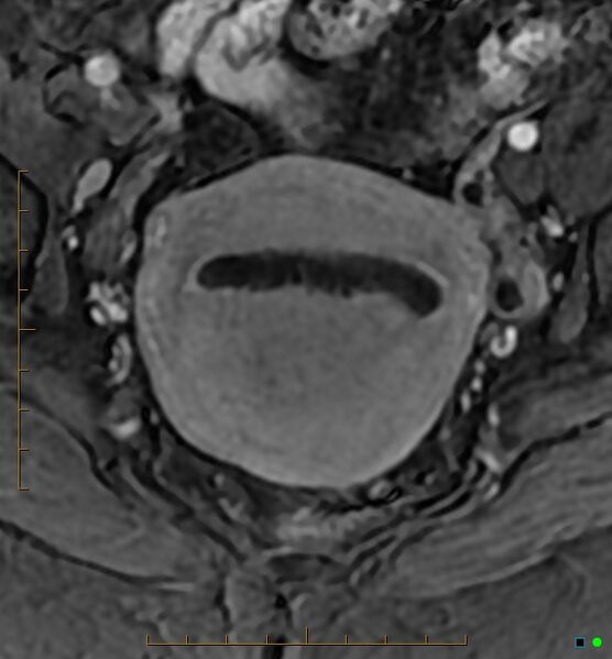 File:Adenomyosis uterus with hematometra (Radiopaedia 45779-50011 Axial T1 C+ fat sat 27).jpg