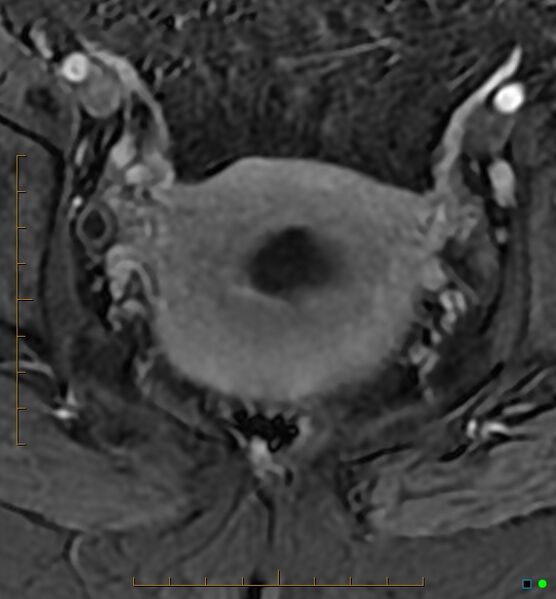 File:Adenomyosis uterus with hematometra (Radiopaedia 45779-50011 Axial T1 C+ fat sat 41).jpg