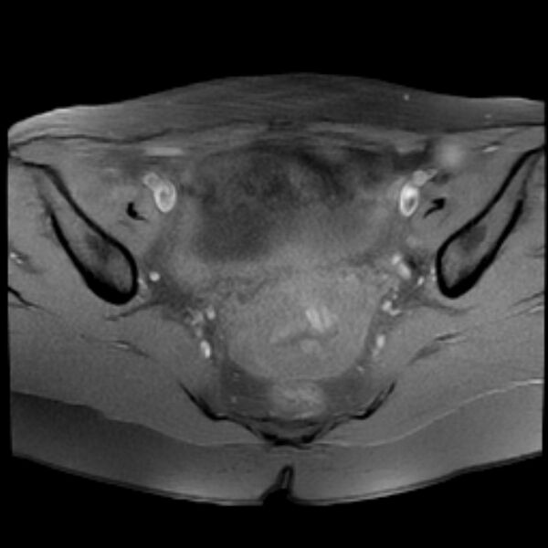 File:Adenomyosis within a septate uterus (Radiopaedia 69963-79981 Axial T1 fat sat 15).jpg