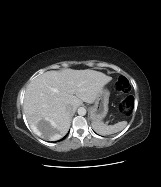 File:Adrenal cortical carcinoma with IVC invasion and thrombosis (Radiopaedia 34307-35597 Axial C+ portal venous phase 16).jpg