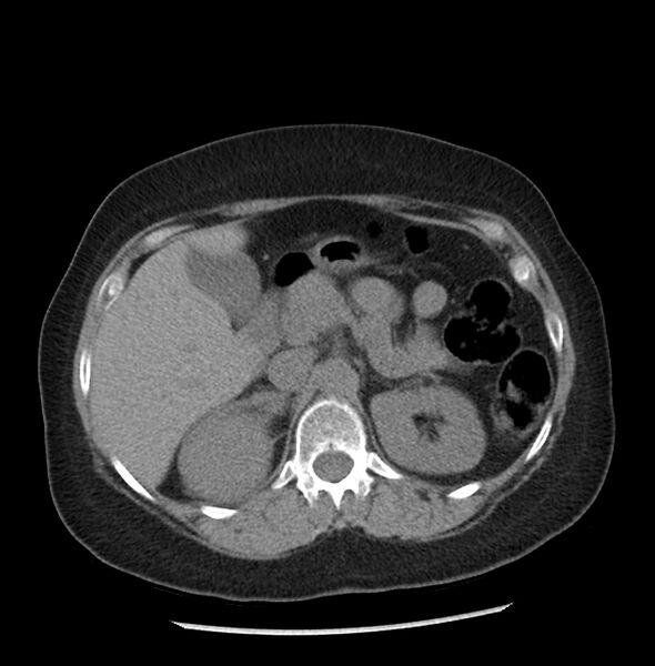 File:Adrenal cortical carcinoma with IVC invasion and thrombosis (Radiopaedia 34307-35597 Axial non-contrast 17).jpg