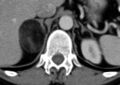 Adrenal myelolipoma (Radiopaedia 14164).jpg