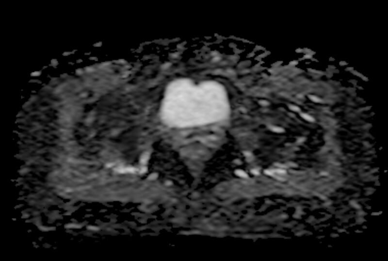 File:Adult granulosa cell tumor of the ovary (Radiopaedia 71581-81950 Axial ADC 22).jpg