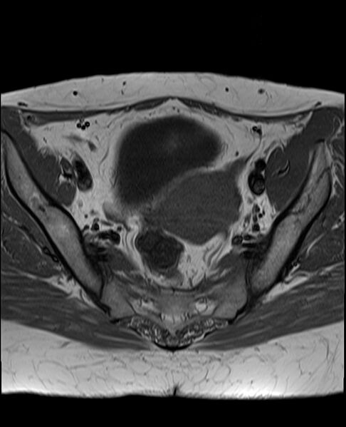 File:Adult granulosa cell tumor of the ovary (Radiopaedia 71581-81950 Axial T1 13).jpg
