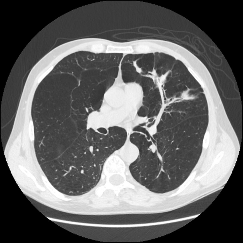 Alpha-1-antitrypsin deficiency (Radiopaedia 40993-43722 Axial lung window 114).jpg