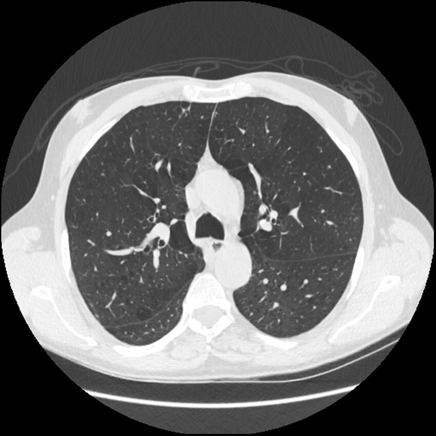 Alpha-1-antitrypsin deficiency (Radiopaedia 40993-43722 Axial lung window 82).jpg