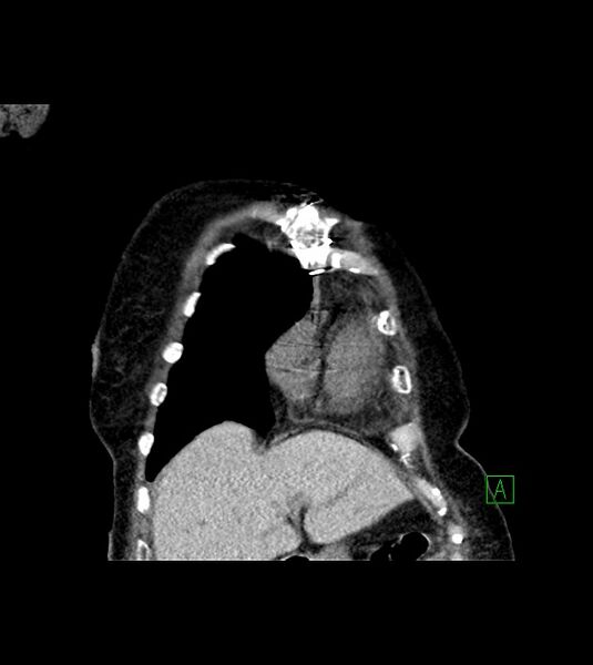 File:Amiodarone deposition in the liver (Radiopaedia 77587-89780 Coronal non-contrast 18).jpg