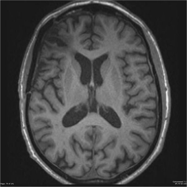 File:Anaplastic meningioma with recurrence (Radiopaedia 34452-35788 Axial T1 77).jpg