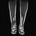 Aneurysmal bone cyst - tibia (Radiopaedia 22343-22367 Coronal T1 9).jpg