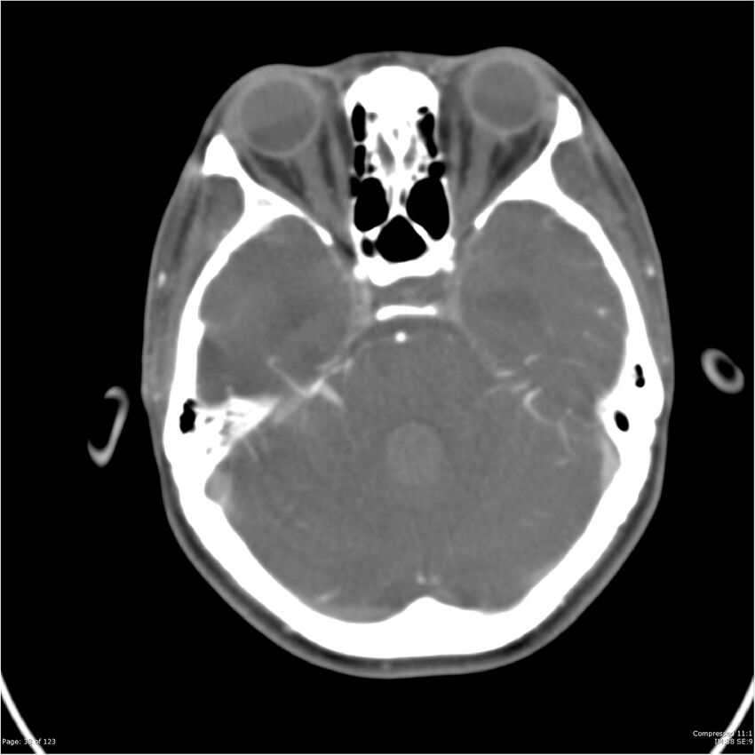 Aneurysmal subarachnoid hemorrhage and Moya Moya disease (Radiopaedia 34306-35593 Axial CT COW 38).jpg