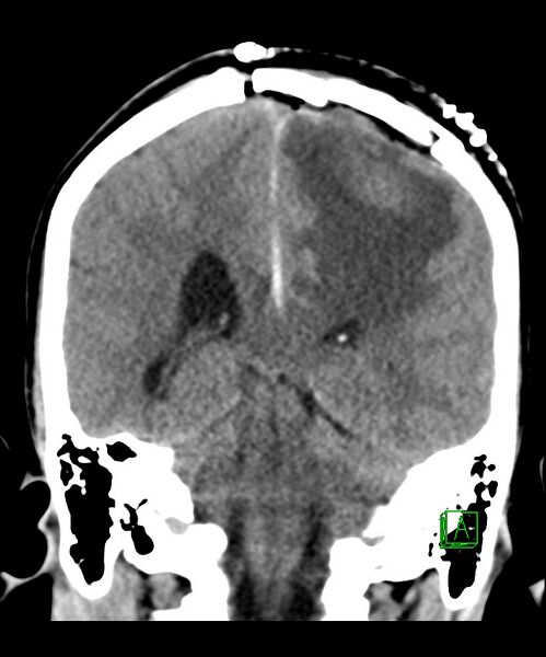 File:Angiomatous meningioma (Radiopaedia 79459-92578 Coronal non-contrast 24).jpg