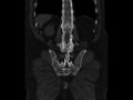 Ankylosing spondylitis (Radiopaedia 44609-48357 Coronal bone window 78).jpg