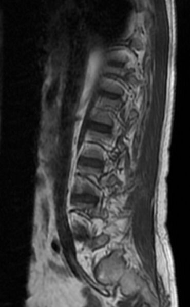 File:Ankylosing spondylitis - Andersson lesion (Radiopaedia 81878-95838 Sagittal T1 3).jpg