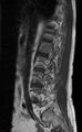 Ankylosing spondylitis - Andersson lesion (Radiopaedia 81878-95838 Sagittal T1 3).jpg