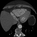 Anomalous origin of left circumflex artery from right coronary sinus (Radiopaedia 72563-83117 B 145).jpg
