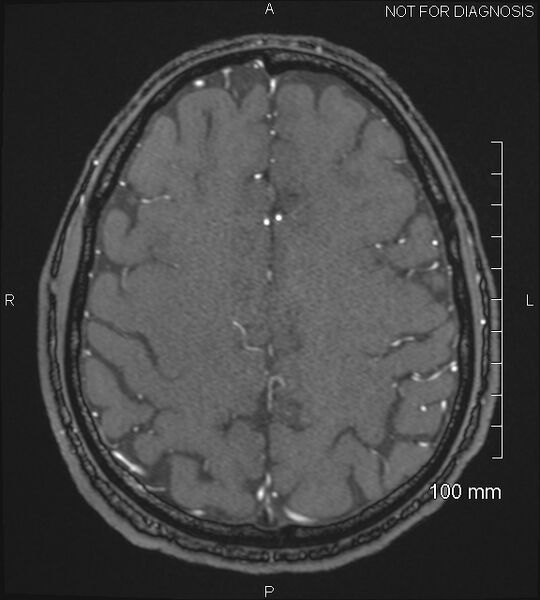 File:Anterior cerebral artery aneurysm (Radiopaedia 80683-94127 Axial MRA 190).jpg
