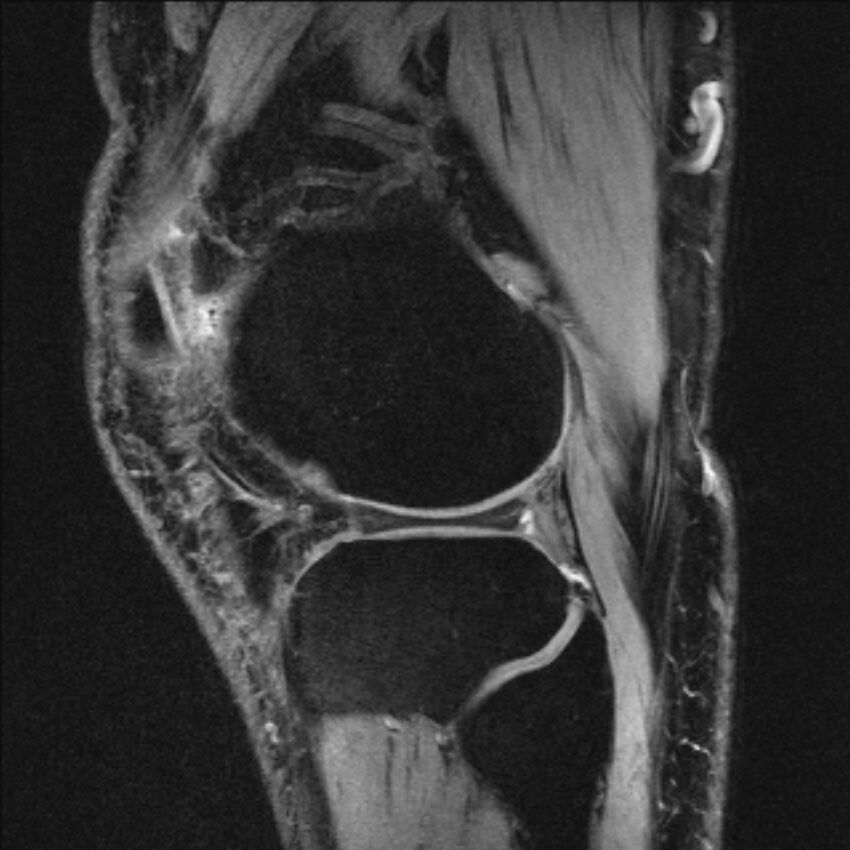 Anterior cruciate ligament mucoid degeneration (Radiopaedia 68400-77933 Sagittal 11).jpg