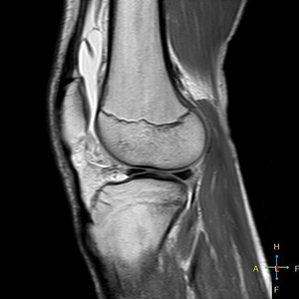 File:Anterior cruciate ligament tear - complete (Radiopaedia 24907-25170 Sagittal PD 5).jpg