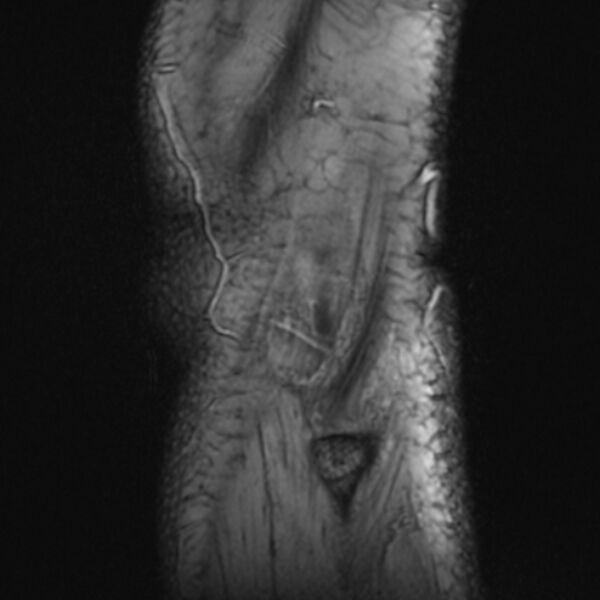 File:Anterior cruciate ligament tear - ramp lesion (Radiopaedia 71883-82322 Sagittal T2 fat sat 2).jpg
