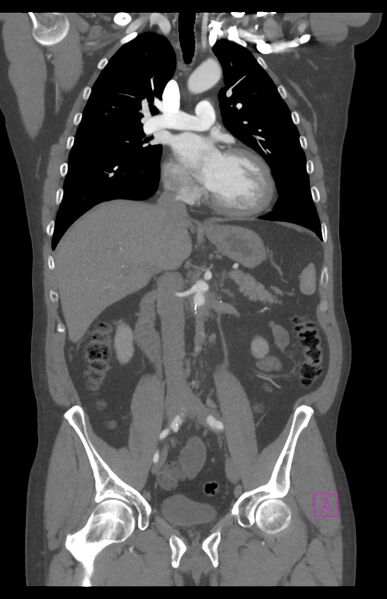 File:Aortectomy and axillary-bifemoral bypass (Radiopaedia 28303-28545 C 46).jpg
