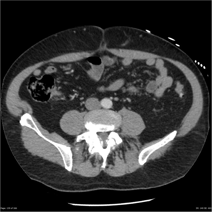 Aortic dissection- Stanford A (Radiopaedia 37759-39664 A 130).jpg
