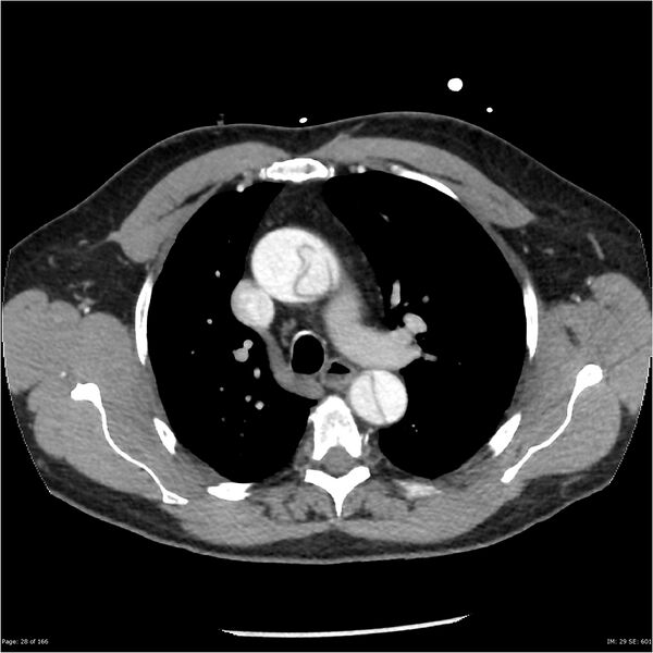File:Aortic dissection- Stanford A (Radiopaedia 37759-39664 A 19).jpg