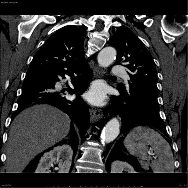 File:Aortic dissection - Stanford type A (Radiopaedia 26183-26315 A 44).jpg