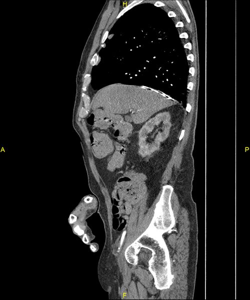 File:Aortoenteric fistula (Radiopaedia 84308-99603 C 102).jpg