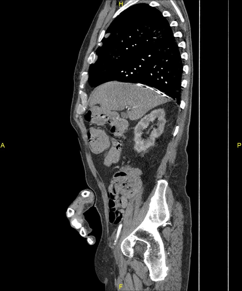 Aortoenteric fistula (Radiopaedia 84308-99603 C 102).jpg