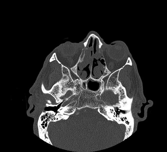 File:Aplastic maxillary sinuses (Radiopaedia 60030-67561 Axial non-contrast 40).jpg