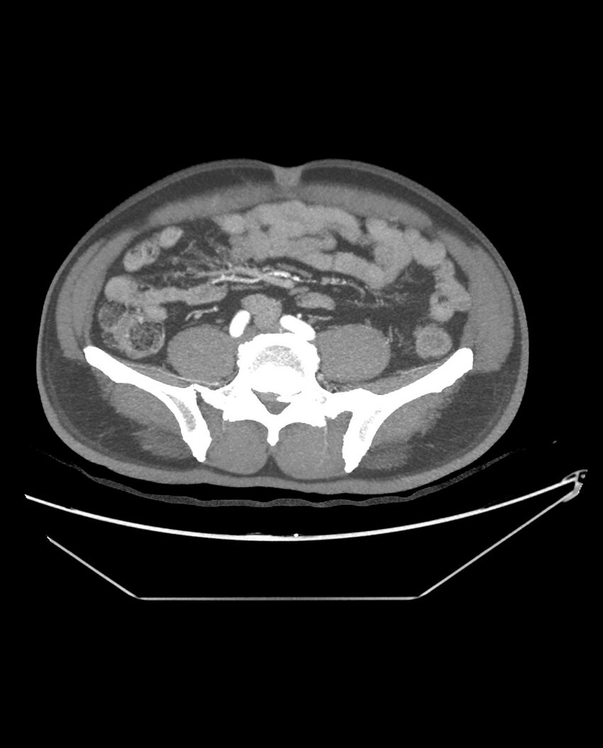 Aplastic posterior tibial arteries (Radiopaedia 84021-99249 A 74).jpg