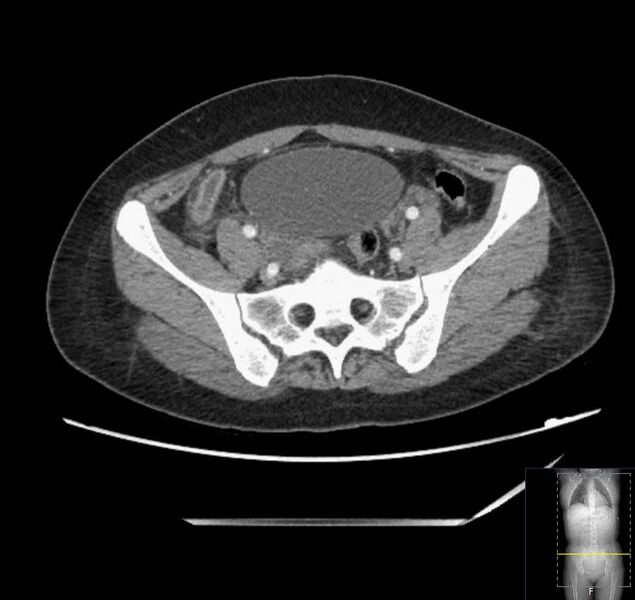 File:Appendicitis (CT angiogram) (Radiopaedia 154713-127660 Axial 1).jpg