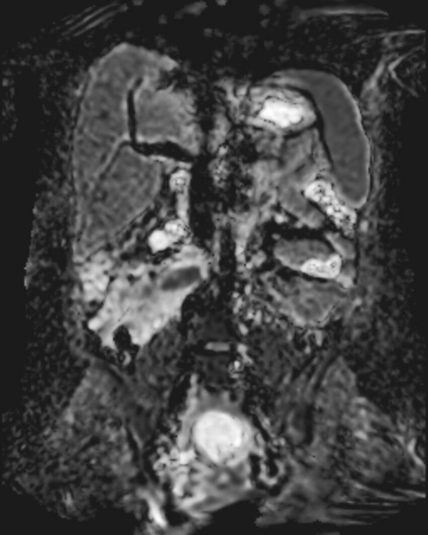 Appendicitis in gravida (MRI) (Radiopaedia 89433-106395 Coronal ADC 32).jpg
