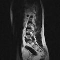 Arachnoid cyst - spinal (Radiopaedia 66835-76157 Sagittal T2 10).jpg