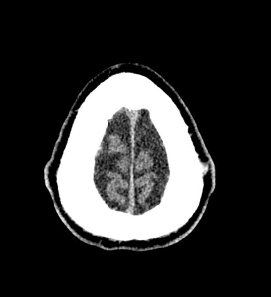 File:Arachnoid cyst of the ambient cistern (Radiopaedia 81301-94986 Axial non-contrast 67).jpg