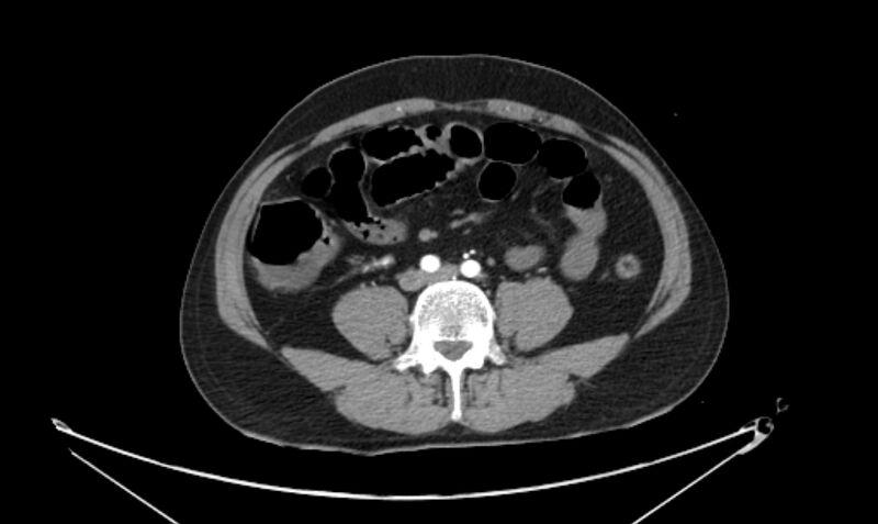File:Arterial occlusive mesenteric ischemia (Radiopaedia 84641-100060 A 83).jpg