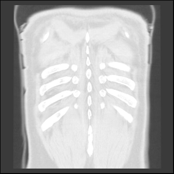 File:Asbestos-related pleural plaques (Radiopaedia 39069-41255 Coronal lung window 4).jpg