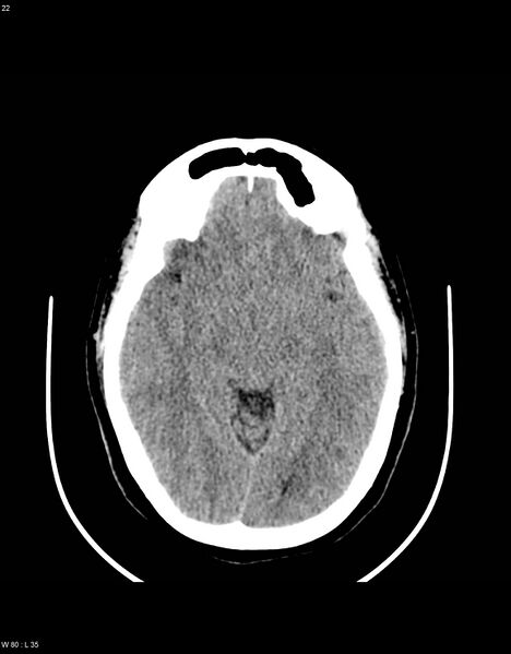 File:Astroblastoma (Radiopaedia 39792-42216 Axial non-contrast 21).jpg